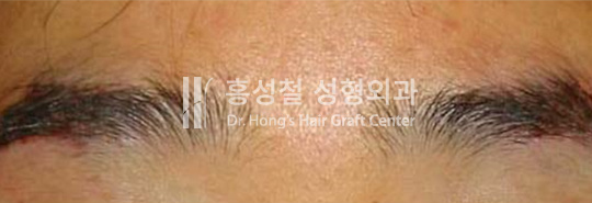 上向きに引き上げて移植した直後