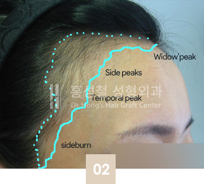 ヘアラインデザイン