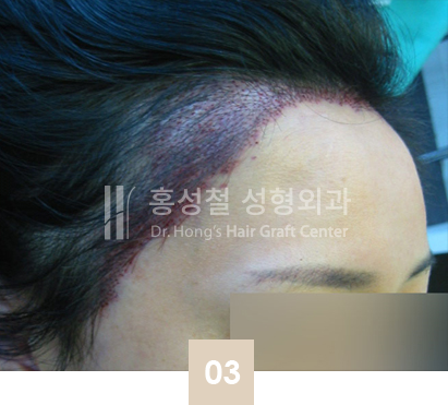 ヘアライン矯正直後の様子