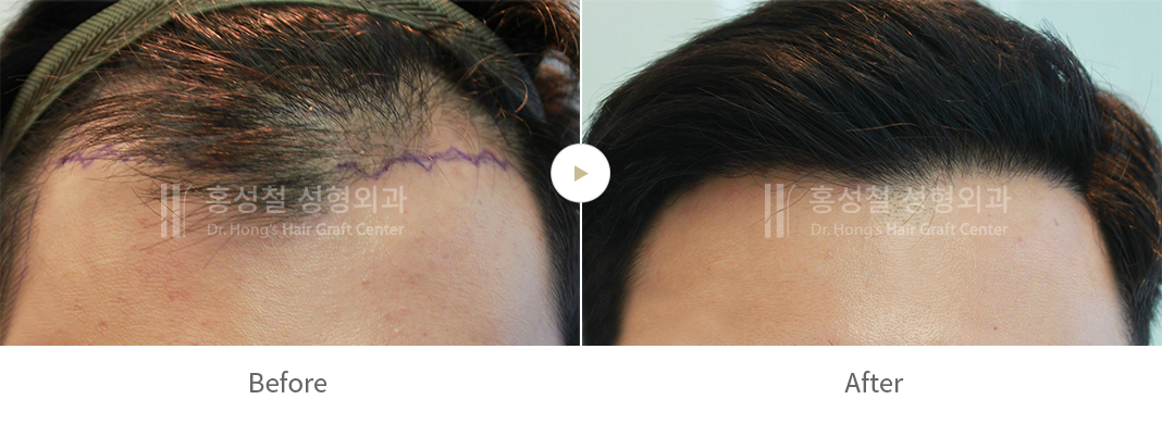 男性のヘアライン — 術前術後の写真